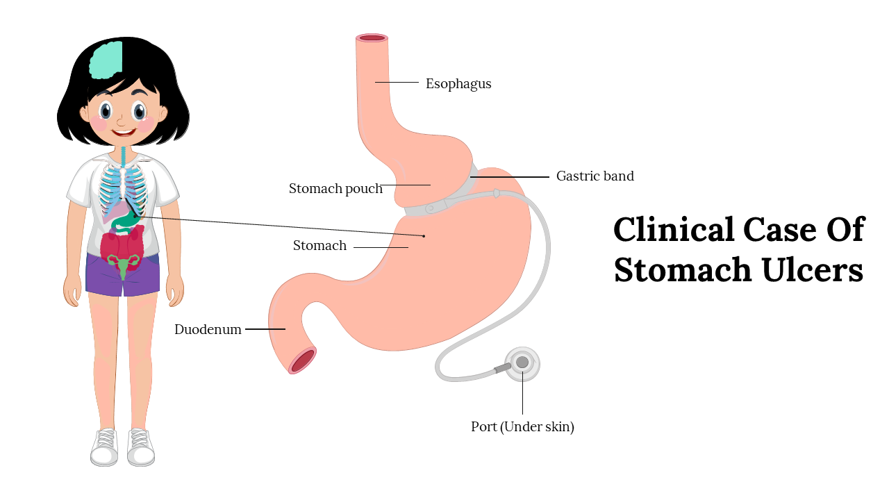 Clinical Case Of Stomach Ulcers