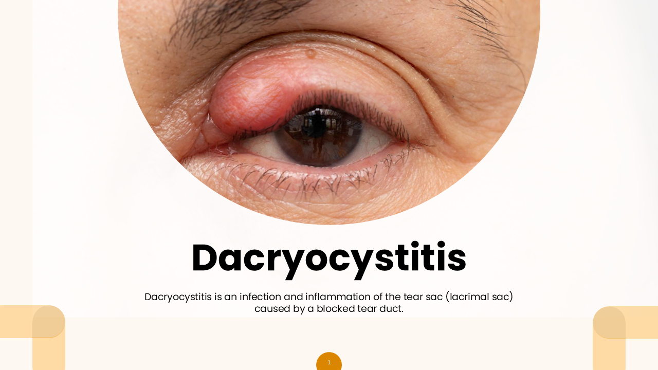 Informative Dacryocystitis PowerPoint And Google Slides