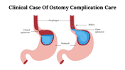 Medical diagram showing ostomy care complications with different conditions of the sphincter and reflux in the stomach.