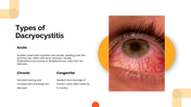Dacryocystitis presentation showing tear sac inflammation, blocked tear duct, symptoms, diagnosis, treatment, and prevention. - slide 4