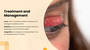 Dacryocystitis presentation showing tear sac inflammation, blocked tear duct, symptoms, diagnosis, treatment, and prevention. - slide 9
