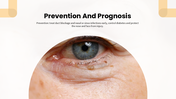 Dacryocystitis presentation showing tear sac inflammation, blocked tear duct, symptoms, diagnosis, treatment, and prevention. - slide 10