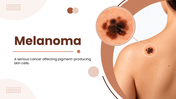 Melanoma overview showing a skin lesion, causes, risk factors, types, symptoms, diagnosis, treatment and prevention. - slide 1