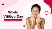 501790-world-vitiligo-day-01