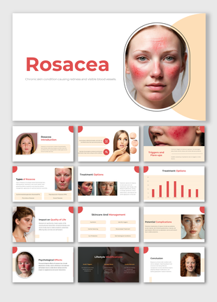 Slide deck explaining rosacea, with photos of affected skin, charts, and treatment options, using beige theme.