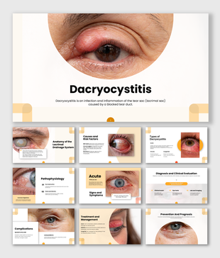 Dacryocystitis presentation showing tear sac inflammation, blocked tear duct, symptoms, diagnosis, treatment, and prevention.