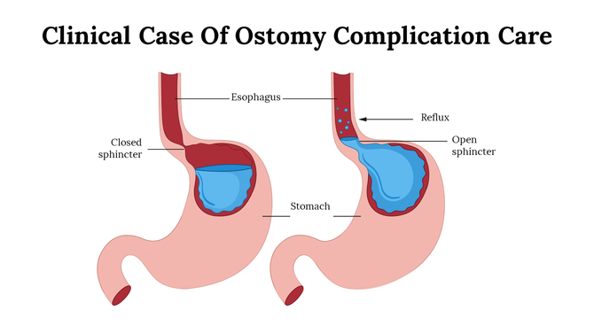 Medical diagram showing ostomy care complications with different conditions of the sphincter and reflux in the stomach.
