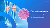 401594-osteosarcoma-01
